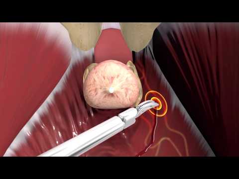 What you need to know prior to prostate surgery