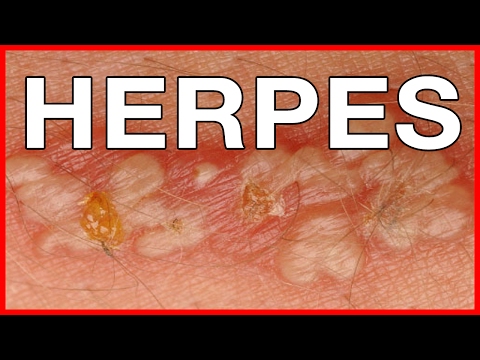 What is Genital Herpes? Symptoms and Treatment
