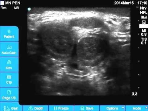 Ultrasound penile anatomy for Dorsal nerve block