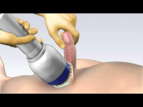 Revolutionary Shockwave Therapy for Erectile Dysfunction