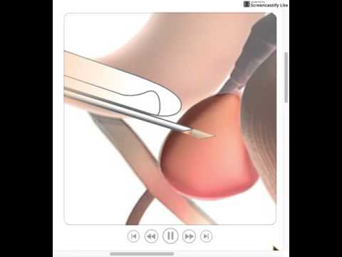 TRUS-Guided Prostate Biopsy
