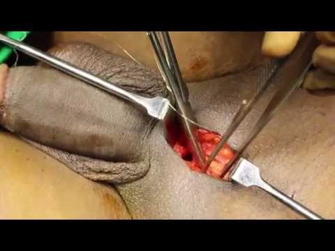 Penis enlargement