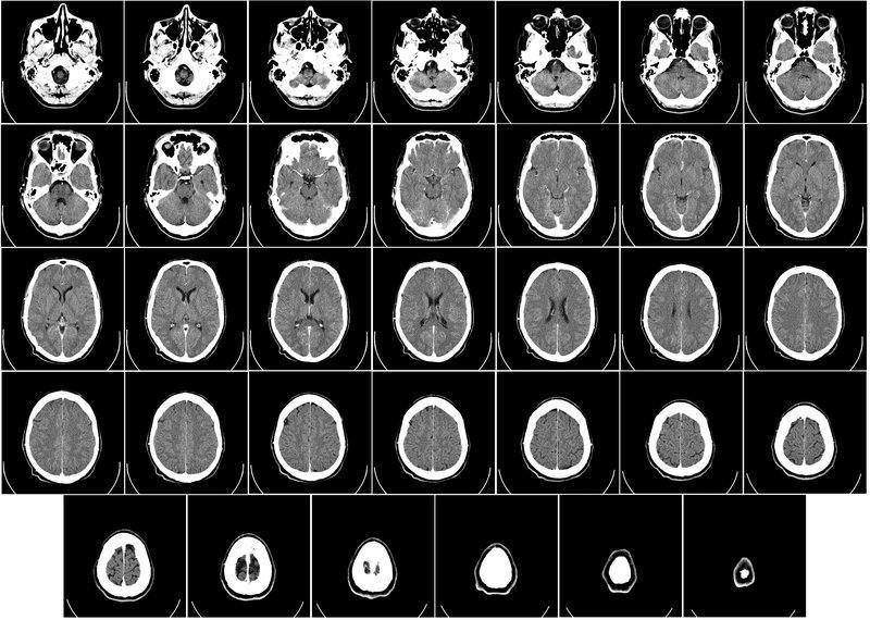 retrográdní ejakulace, neurologické příčiny