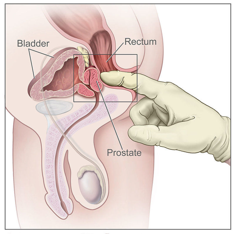 vyšerení prostaty