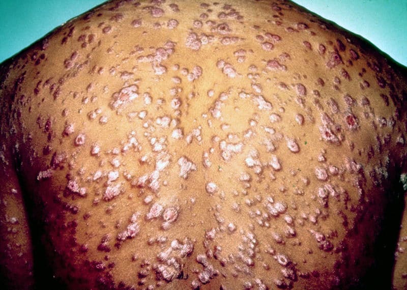 příznaky syfilisu