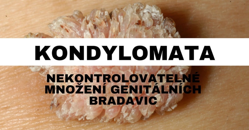 kondylomata