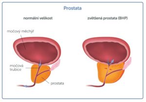 velikost prostaty