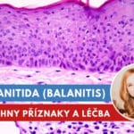 balanitida, balanitis