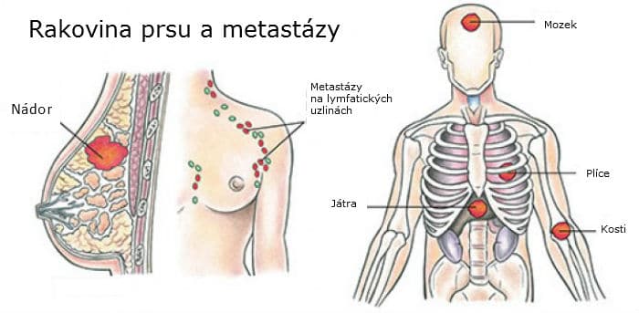 metastáze rakoviny prsu