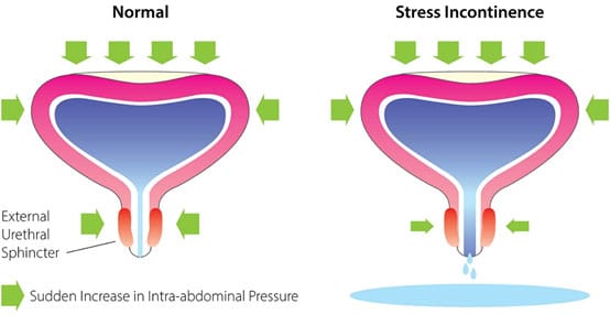 stresová inkontinence