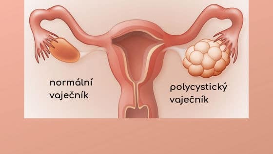 normální a polycystický vaječník