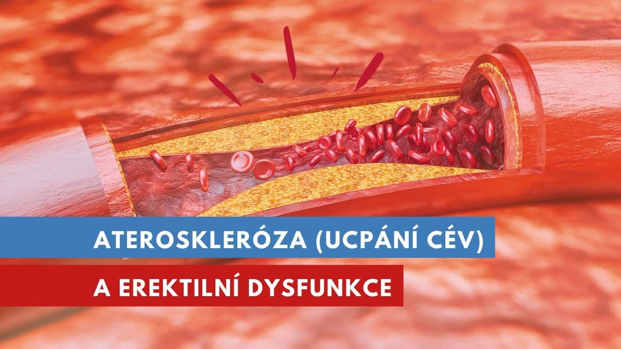 ateroskleróza a erektilní dysfunkce