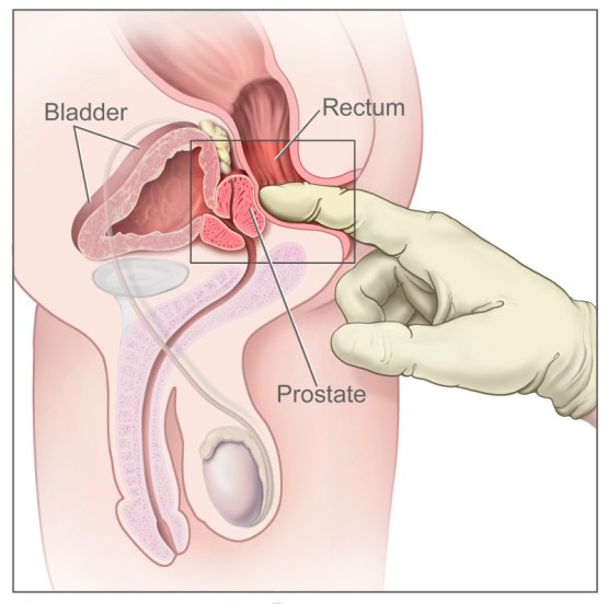 hmatové vyšetření prostaty přes konečník