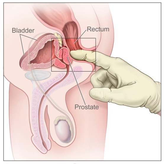 teste de laborator ale prostatitei)