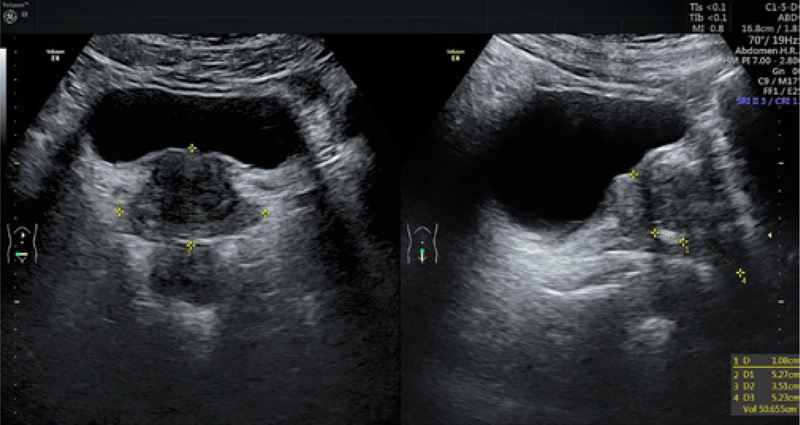 ultrazvuková sonografie prostaty