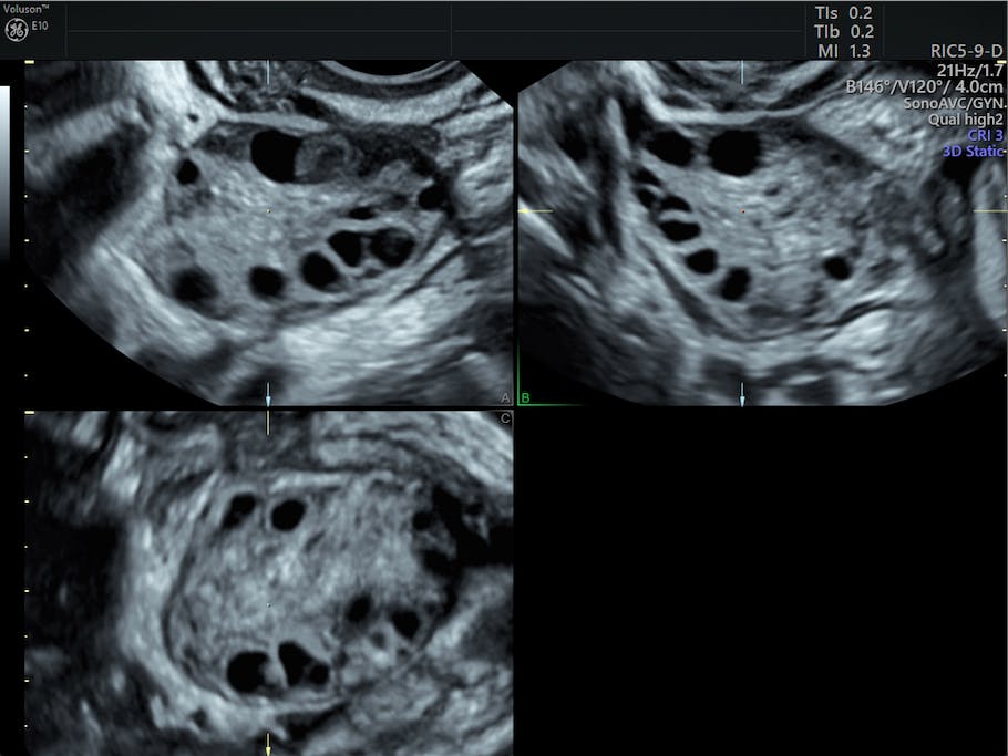 PCOS pod ultrazvukovým vyšetřením