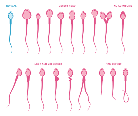 teratozoospermia