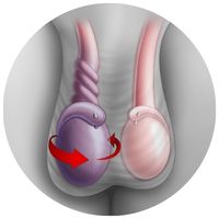 zvětšení varlat kvůli torzi