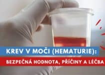 krev v moči, hematurie