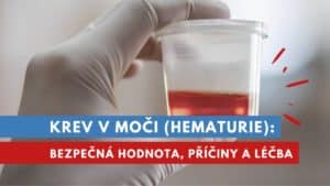 krev v moči, hematurie