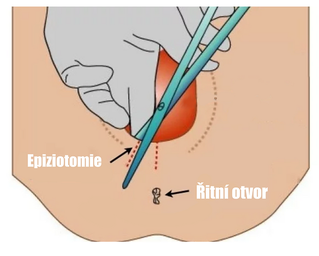 epiziotomie, nástřih hráze při porodu