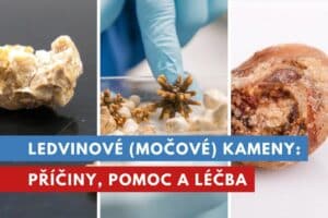 ledvinové kameny, konkrementy