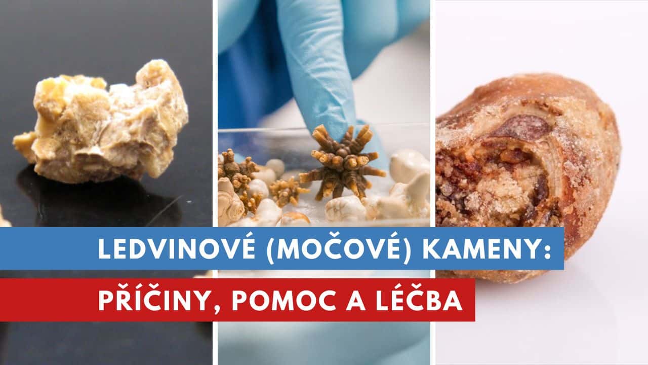 Jak se vysetruji močové kameny?