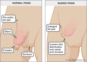 zanořený penis u kojence