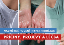 nadměrné pocení, hyperhidróza