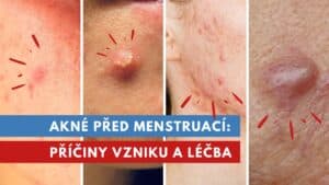 akné před menstruací