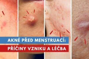 akné před menstruací