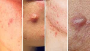 akné před menstruací, papuly, pustuly, noduly a cysty