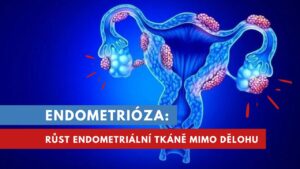 endometrióza