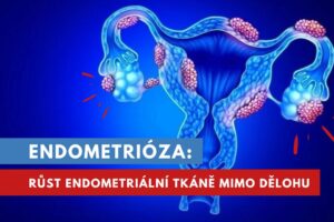 endometrióza