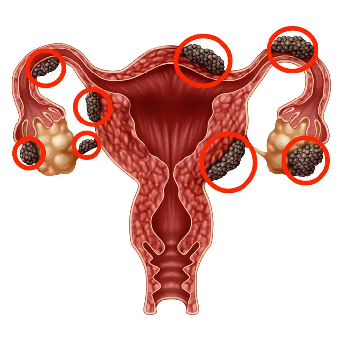 ložiska endometriózy