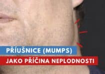 příušnice, mumps, epidemická parotitida