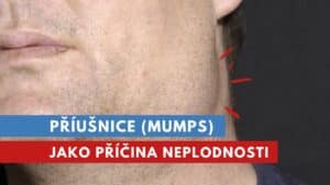 příušnice, mumps, epidemická parotitida