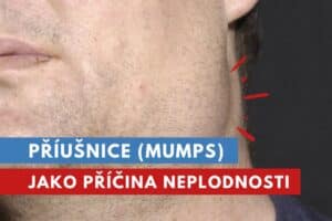 příušnice, mumps, epidemická parotitida