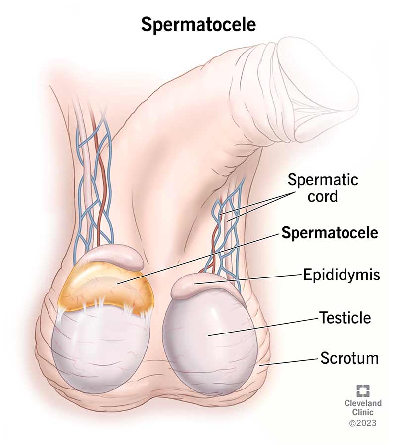 spermatokéla