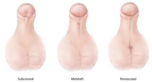 typy hypospadie