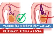 varikokéla, křečové žíly na varlatech