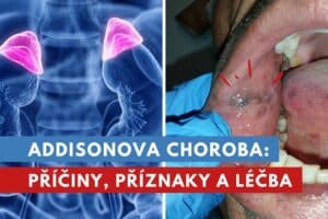 Addisonova choroba