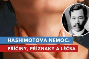 hashimotova nemoc
