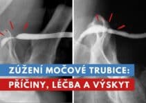 zúžení močové trubice
