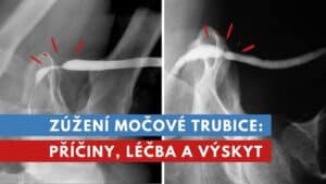 zúžení močové trubice