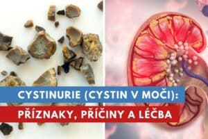 cystinurie
