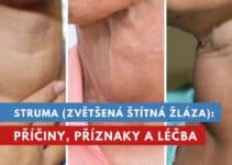 struma, zvětšená štítná žláza