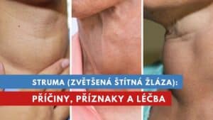 struma, zvětšená štítná žláza