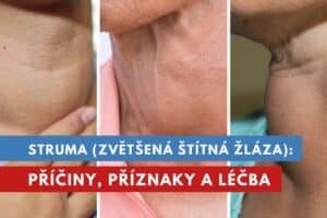 struma, zvětšená štítná žláza